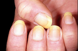 নখের রঙ দেখে যেভাবে বুঝবেন আপনার কোন ভয়ংকর রোগ আছে কি না!