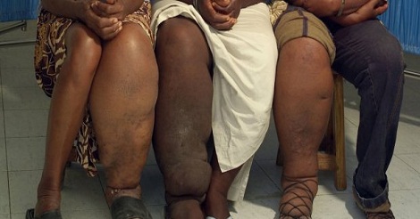 ফাইলেরিয়া বা গোদ রোগের কারন, লক্ষণ ও চিকিৎসা