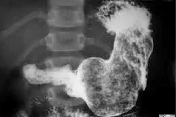 বারো বছরের মেয়ের পাকস্থলীটে মিলল আড়াই কেজি চুল!