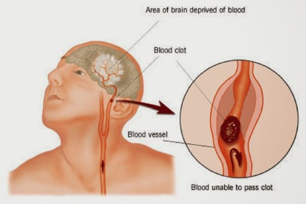বিশ্বে প্রতি ছয় সেকেন্ড অন্তর একজন স্ট্রোকে মারা যান৷