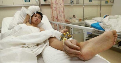 কাটা হাত পায়ে যুক্ত করে রক্ষা